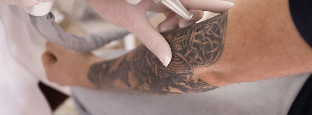La mejor titulación necesaria para quitar tatuajes